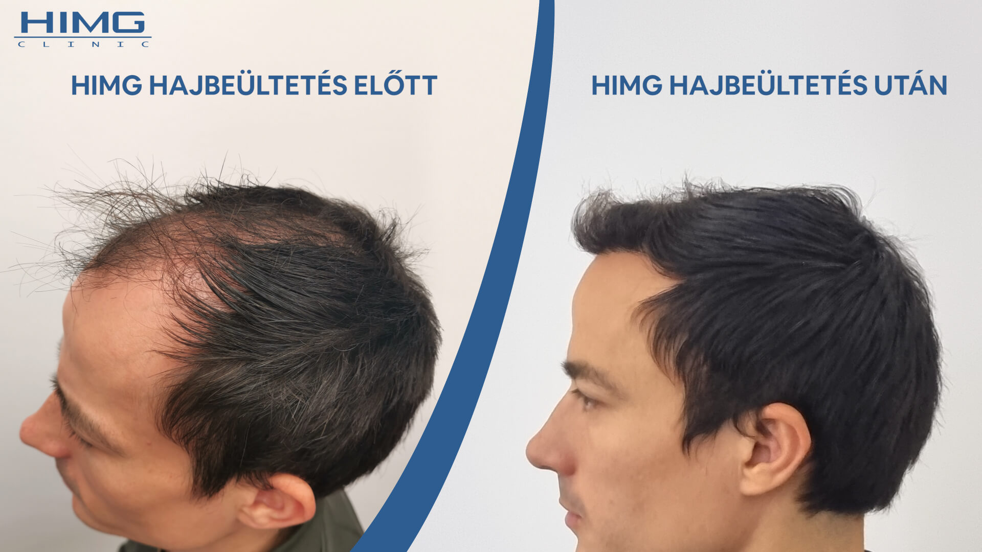 A budapesti HIMG klinikán történt hajbeültetés eredménye