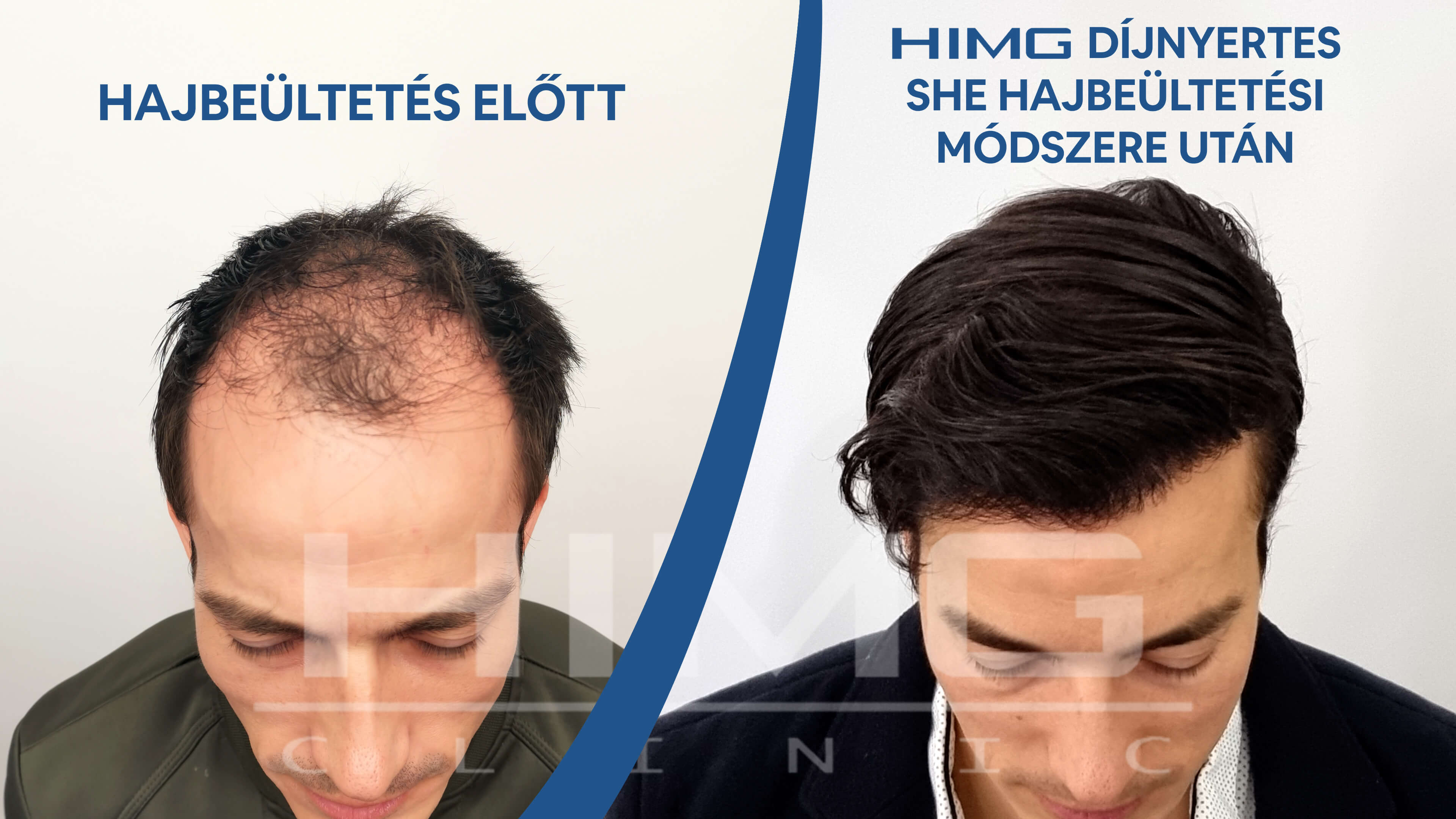 Balázs hajbeültetés előtt és után