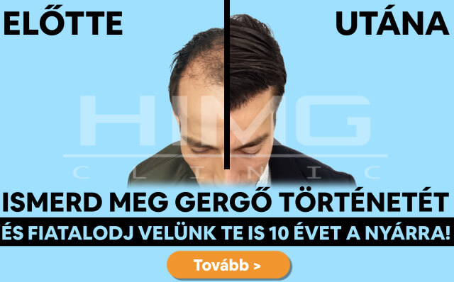 HIMG hajbeültetés akció