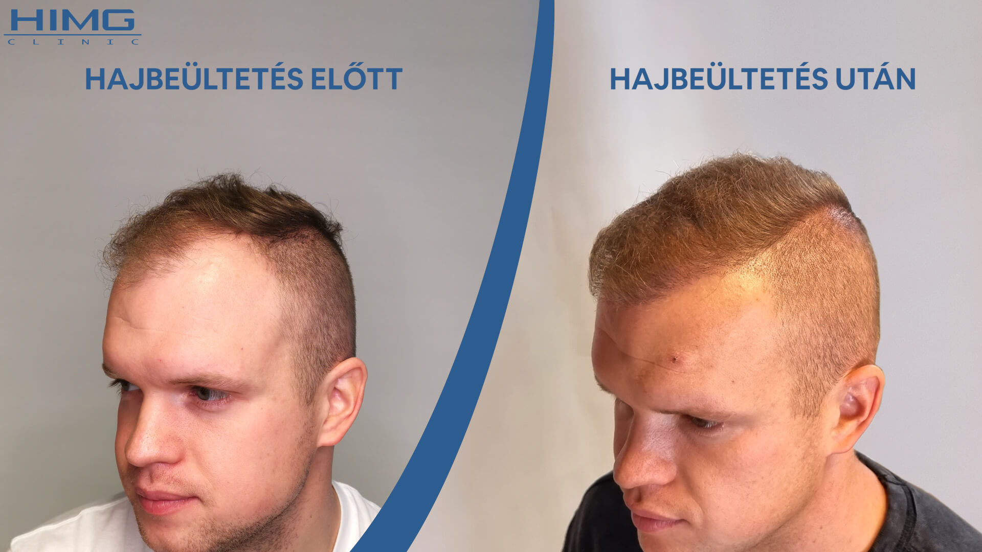 Patrik a hajbeültetés előtt és utána