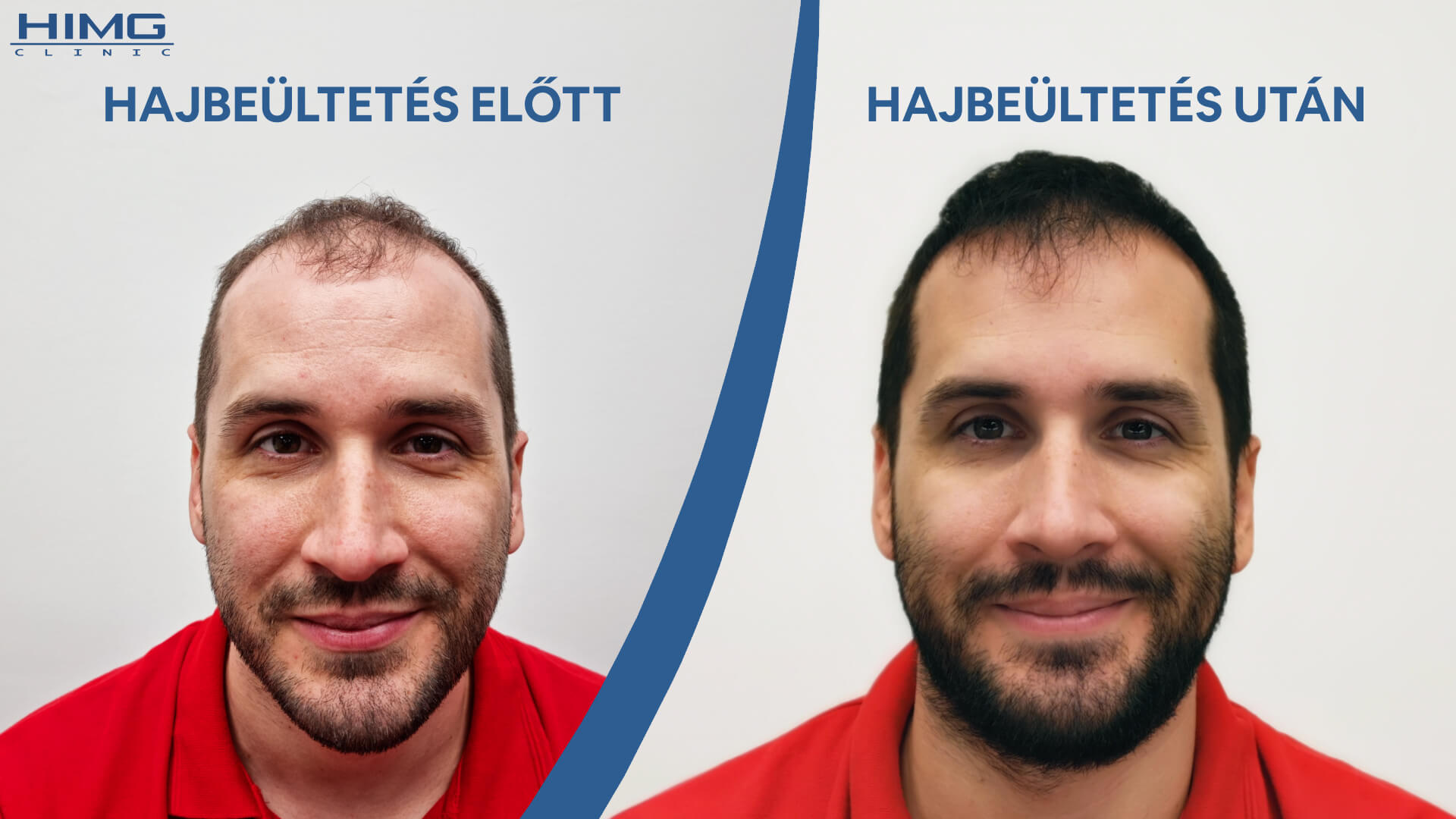 Hajbeültetés Előtt és Után