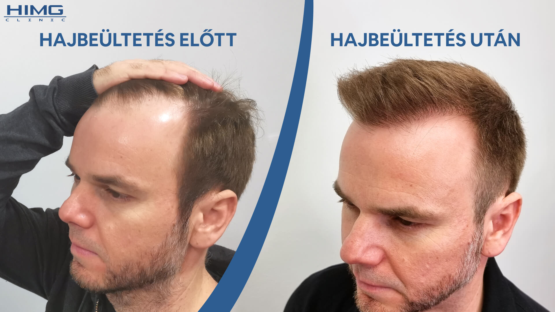 Hajbeültetés előtt és után